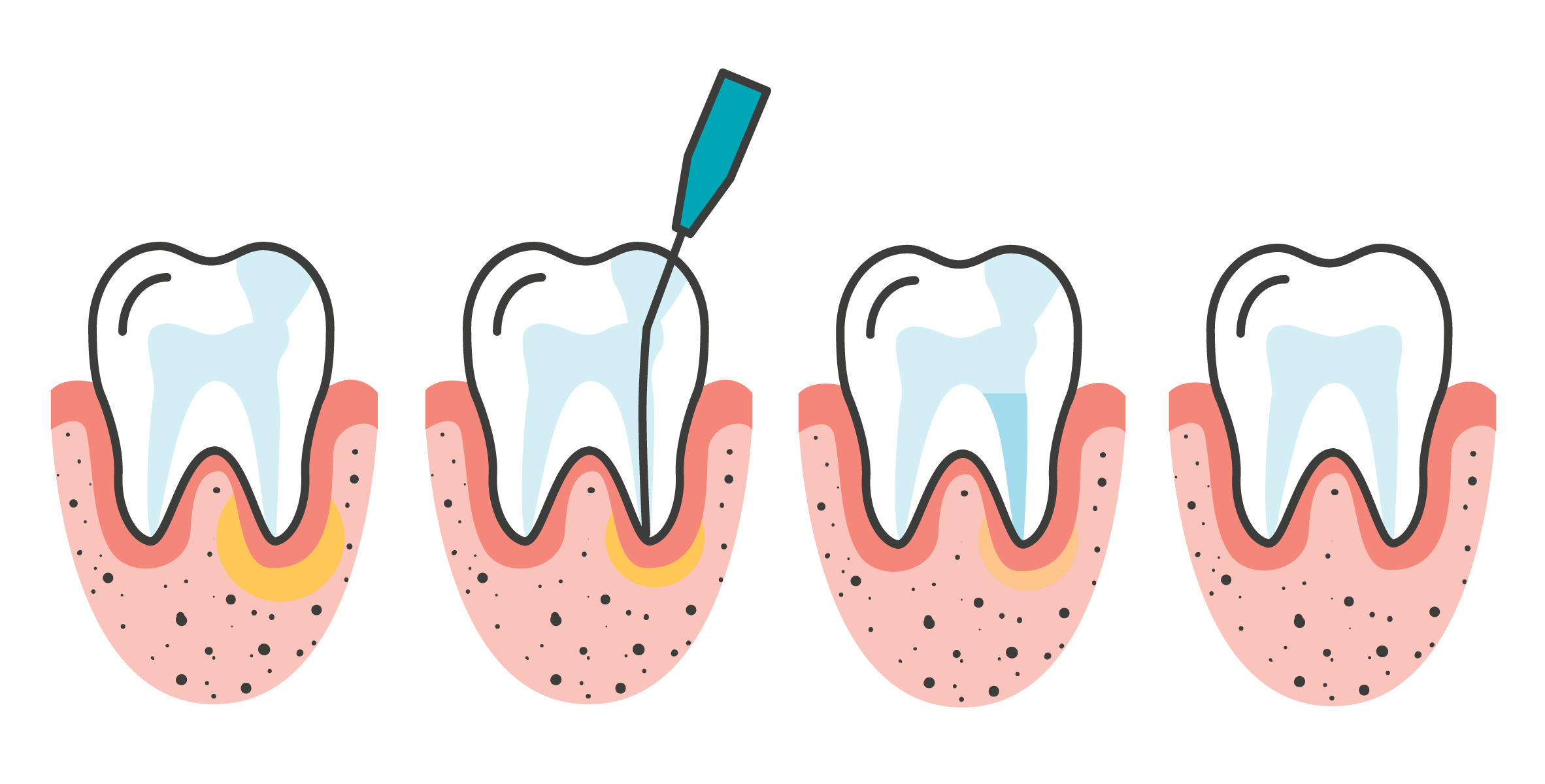 Maven Dental Route Canal