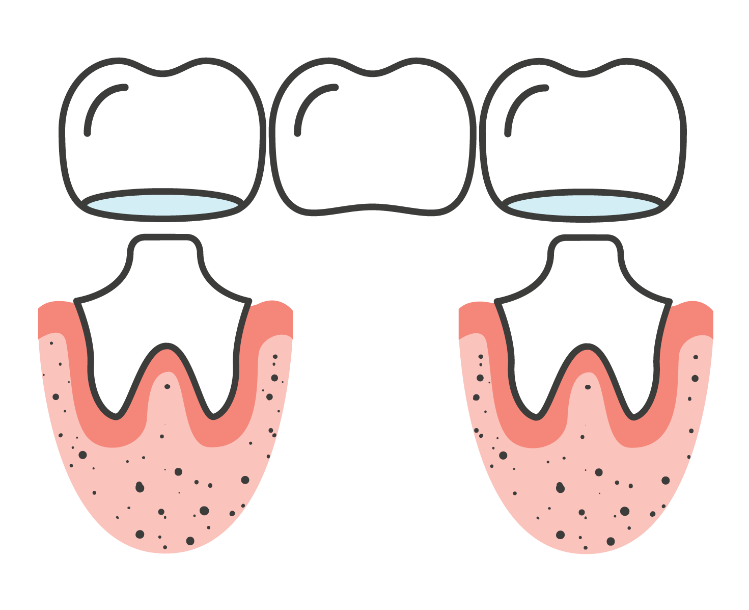 Maven Dental Bridges