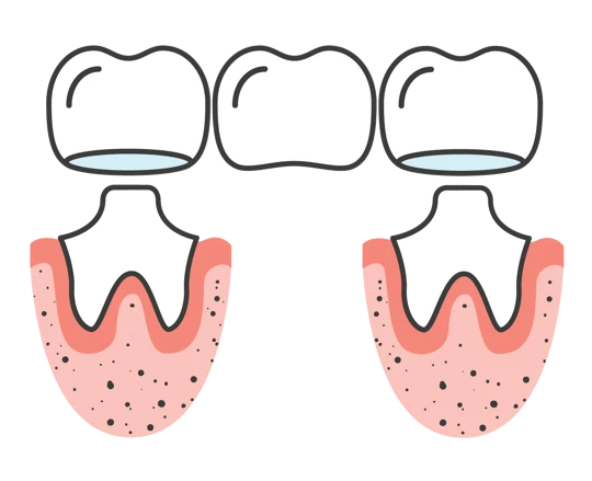 Maven Dental Bridges