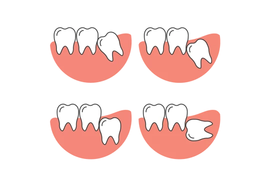 Maven Dental Wisdom Teeth