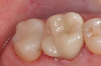 Gympie Dentist Amalgam Removal After