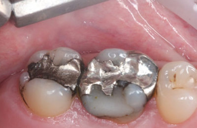 Gympie Dentist Amalgam Removal Before