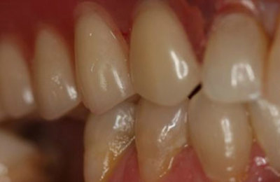 After Channon Lawrence Dental Dentures
