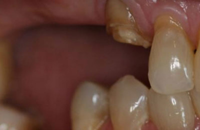 Dentures Before