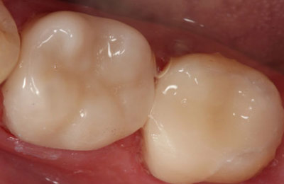 Gympie dental crown treatment after