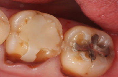 Gympie dental crown treatment before