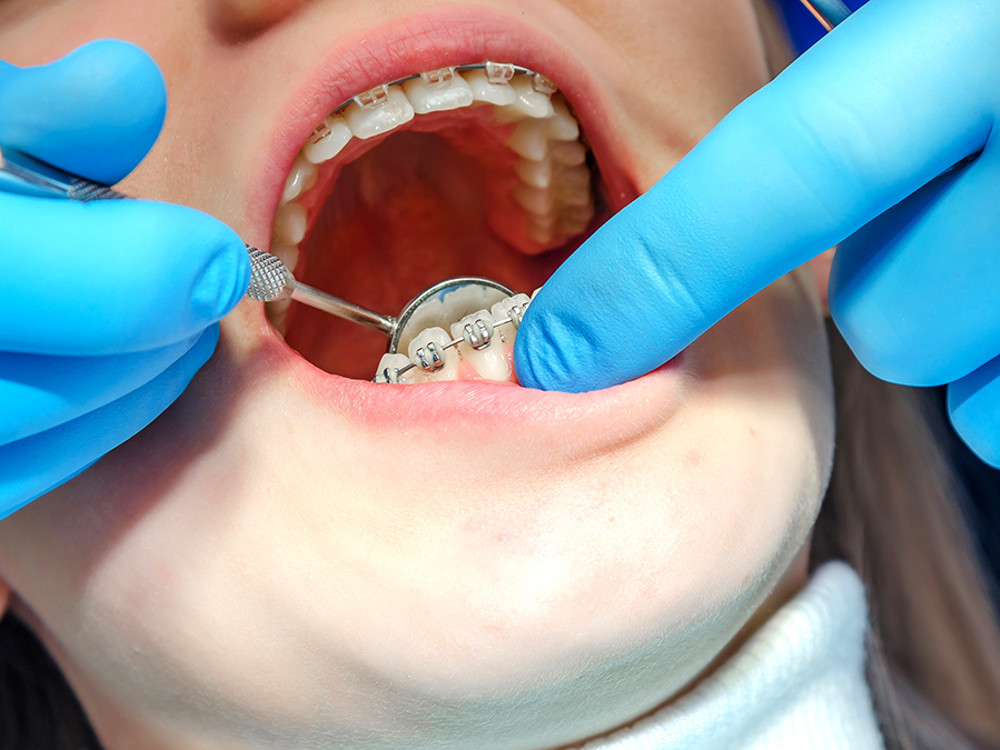 Maven Dental braces care patient in dental chair