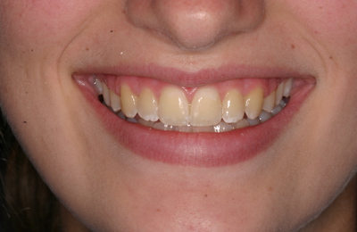 Kirs After Invisalign (2)