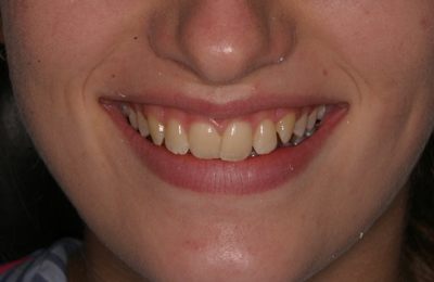 Kirs Before Invisalign