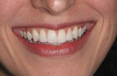 Smile After Invisalign