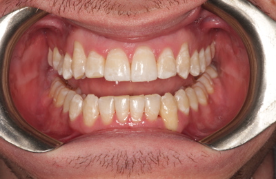 Tim Invisalign After