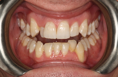 Tim Invisalign Before