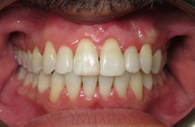 Marco Invisalign After