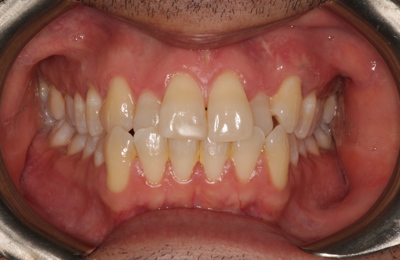 Marco Invisalign Before