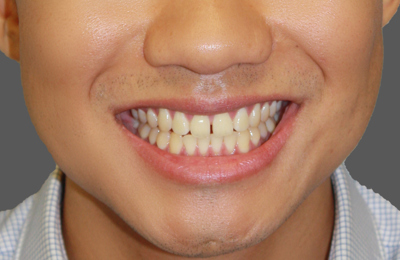 Before Teeth whitening and veneers treatment Dr Celso Cardona Maven Dental Sydney 