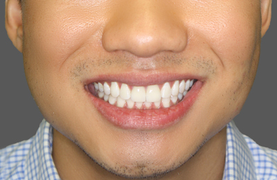 After Teeth whitening and veneers treatment Dr Celso Cardona Maven Dental Sydney 