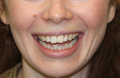 Before Teeth whitening and Invisalign treatment Dr Celso Cardona Maven Dental Sydney 