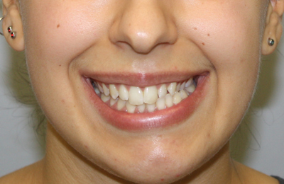Before Teeth whitening and Invisalign treatment Dr Celso Cardona Maven Dental Sydney 