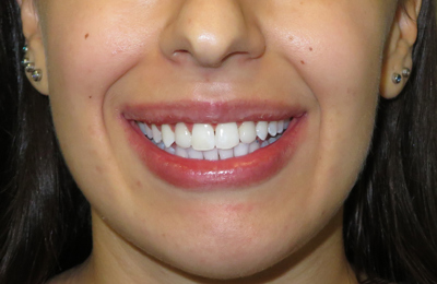 After Teeth whitening and Invisalign treatment Dr Celso Cardona Maven Dental Sydney 