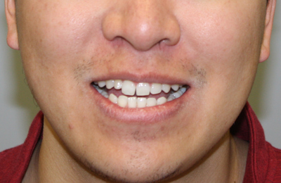Before Teeth whitening, veneers and Invisalign treatment Dr Celso Cardona Maven Dental Sydney 