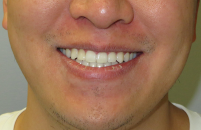 After Teeth whitening, veneers and Invisalign treatment Dr Celso Cardona Maven Dental Sydney 