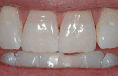 After results of Zoom in-chair teeth whitening at Maven Dental Southport 
