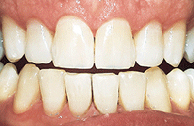 After results Zoom in-chair teeth whitening at Maven Dental Southport 