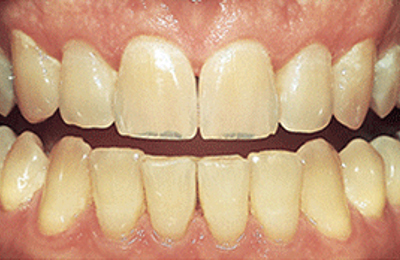 Before results Zoom in-chair teeth whitening at Maven Dental Southport 