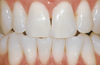 After results Zoom in-chair teeth whitening at Maven Dental Southport 
