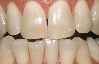 Before results Zoom in-chair teeth whitening at Maven Dental Southport 