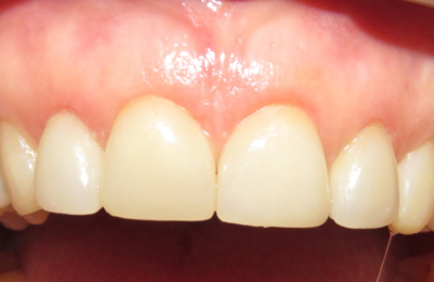 After Dental Bridge Maven Dental Southport | Dentist Gold Coast 