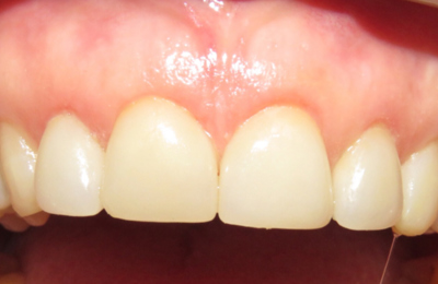 After Dental Bridge Maven Dental Southport | Dentist Gold Coast