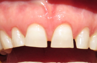 Before Dental Bridge Maven Dental Southport | Dentist Gold Coast 