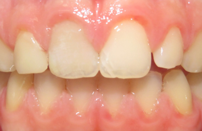 After Dental Bridge Maven Dental Southport | Dentist Gold Coast 