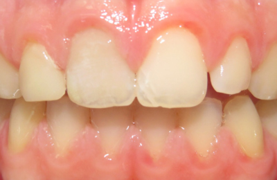 After Dental Bridge Maven Dental Southport | Dentist Gold Coast