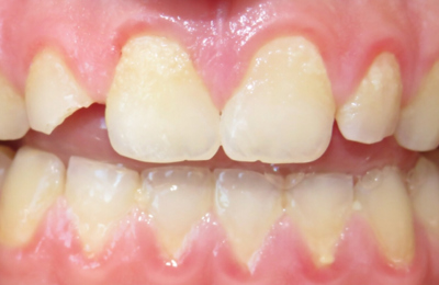 Before Dental Bridge Maven Dental Southport | Dentist Gold Coast 
