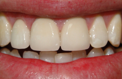 After Dental Bridge Maven Dental Southport | Dentist Gold Coast