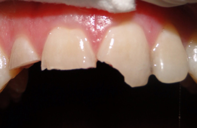 Before Dental Bridge Maven Dental Southport | Dentist Gold Coast