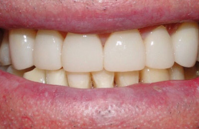 Teeth after dental crown treatment | Dentist Maven Dental Southport