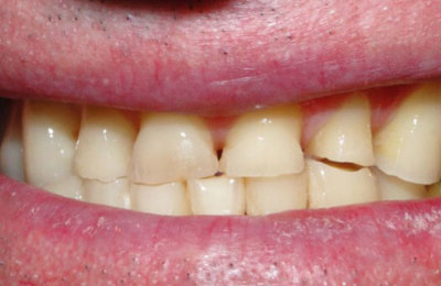 Teeth before dental crown treatment | Dentist Maven Dental Southport