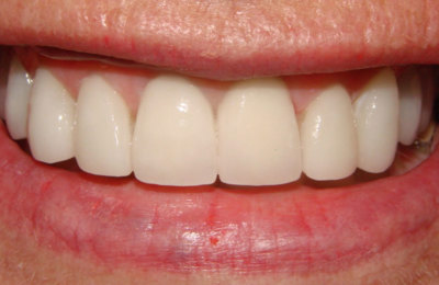 Teeth after veneers and dental crown treatment | Dentist Maven Dental Southport