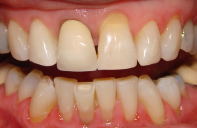 Teeth before veneers and dental crown treatment | Dentist Maven Dental Southport