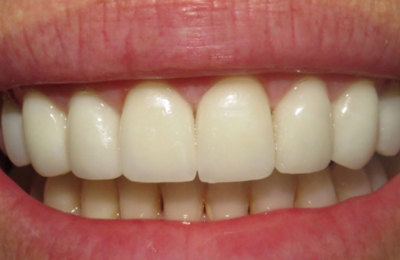Teeth After Veneers treatment | Dentist Maven Dental Southport