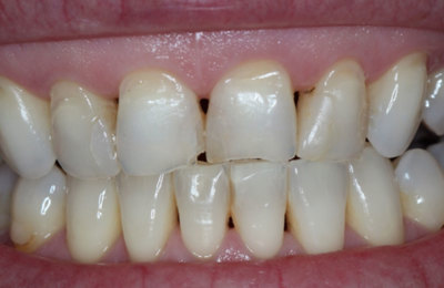Teeth before Veneers treatment | Dentist Maven Dental Southport